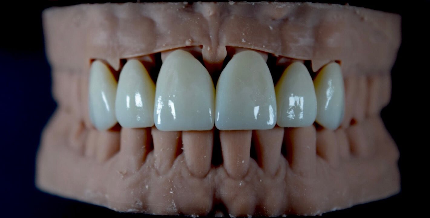 Premium Zirconia Post