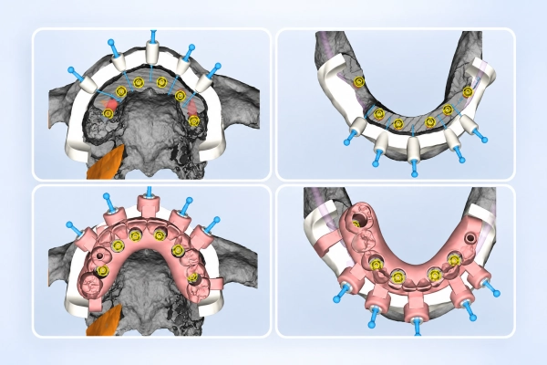 Dental Implant Restorations 16 Digital Implant Planning Design