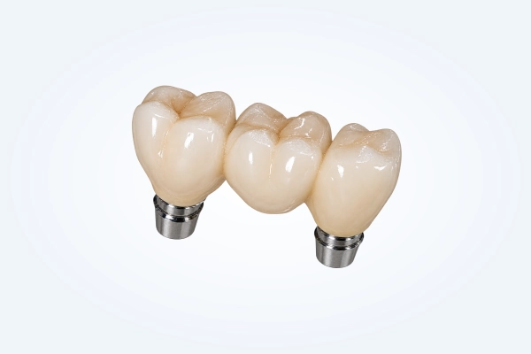 Dental Implant Restorations 10 Implant Supported Bridges