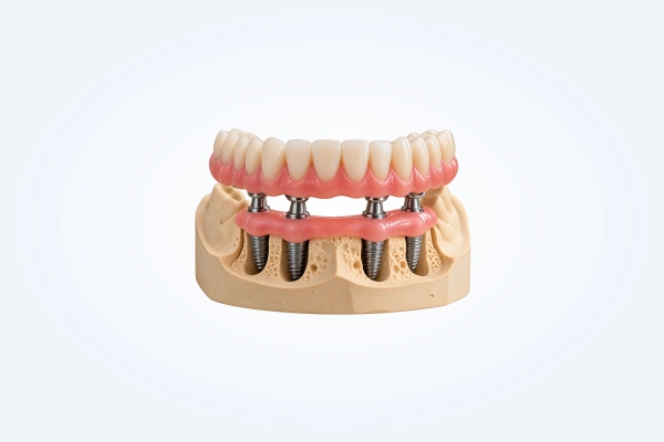 Dental Implant Restorations 14 Implant Supported Dentures
