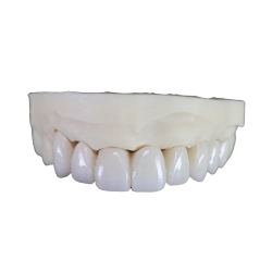 Multilayered Zirconia Crown